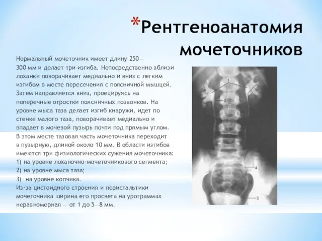Рентгеноанатомия мочеточников Нормальный мочеточник имеет длину 250— 300 мм и делает три изгиба.