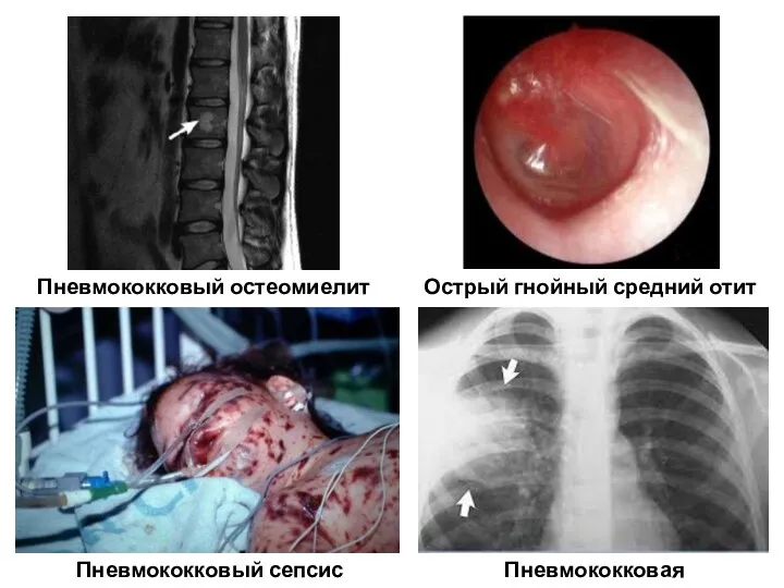 Пневмококковый сепсис Пневмококковый остеомиелит Острый гнойный средний отит Пневмококковая пневмония