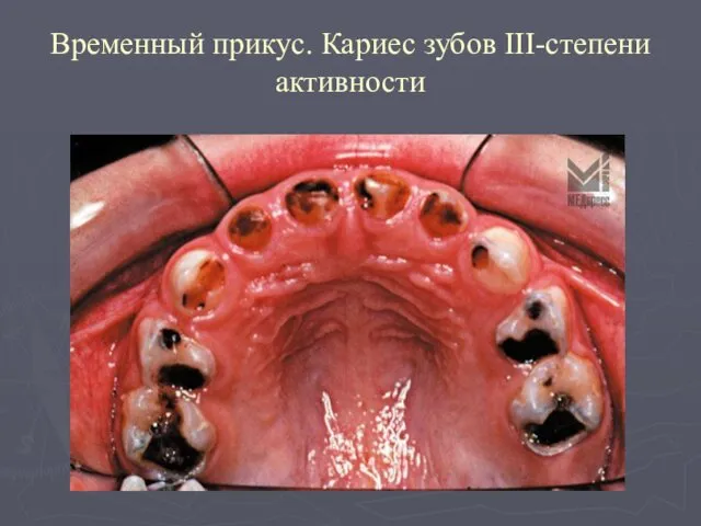 Временный прикус. Кариес зубов III-степени активности