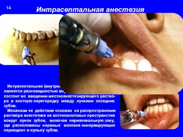 Интрасептальная (внутриперегородочная) анестезия является разновидностью внутрикостной анестезии и состоит во введении местноанестезирующего раство-