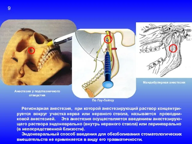 Проводниковая анестезия Регионарная анестезия, при которой анестезирующий раствор концентри- руется вокруг участка нерва