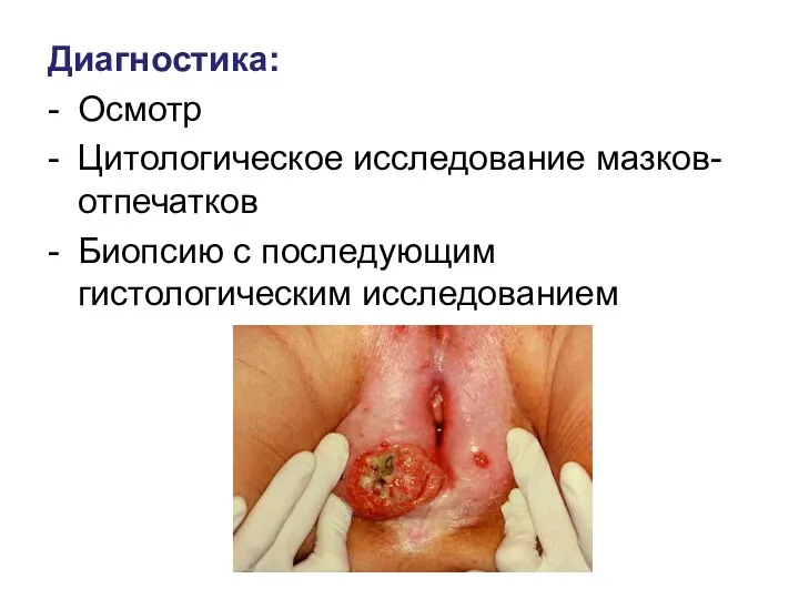 Диагностика: - Осмотр - Цитологическое исследование мазков-отпечатков - Биопсию с последующим гистологическим исследованием