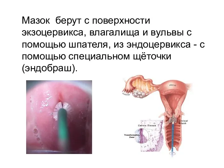 Мазок берут с поверхности экзоцервикса, влагалища и вульвы с помощью