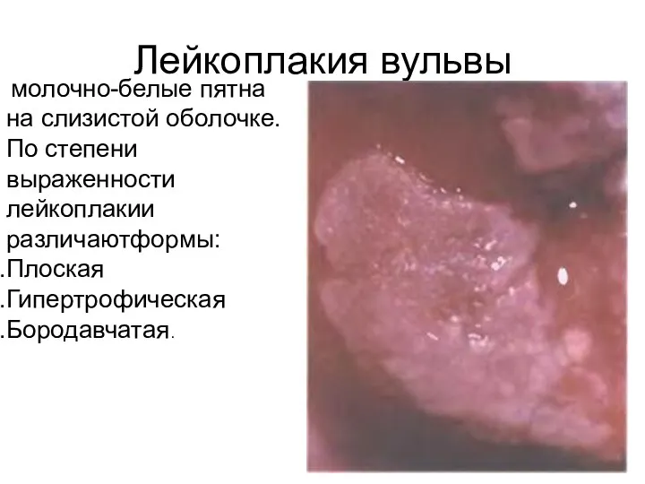 Лейкоплакия вульвы молочно-белые пятна на слизистой оболочке. По степени выраженности лейкоплакии различаютформы: Плоская Гипертрофическая Бородавчатая.