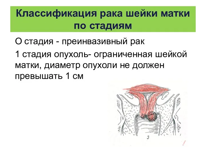 Классификация рака шейки матки по стадиям О стадия - преинвазивный