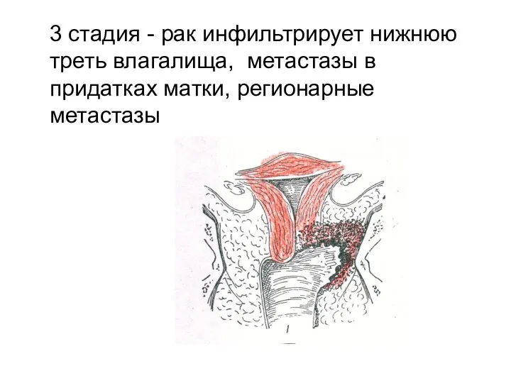 3 стадия - рак инфильтрирует нижнюю треть влагалища, метастазы в придатках матки, регионарные метастазы