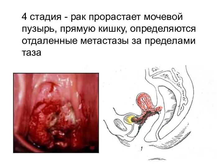 4 стадия - рак прорастает мочевой пузырь, прямую кишку, определяются отдаленные метастазы за пределами таза