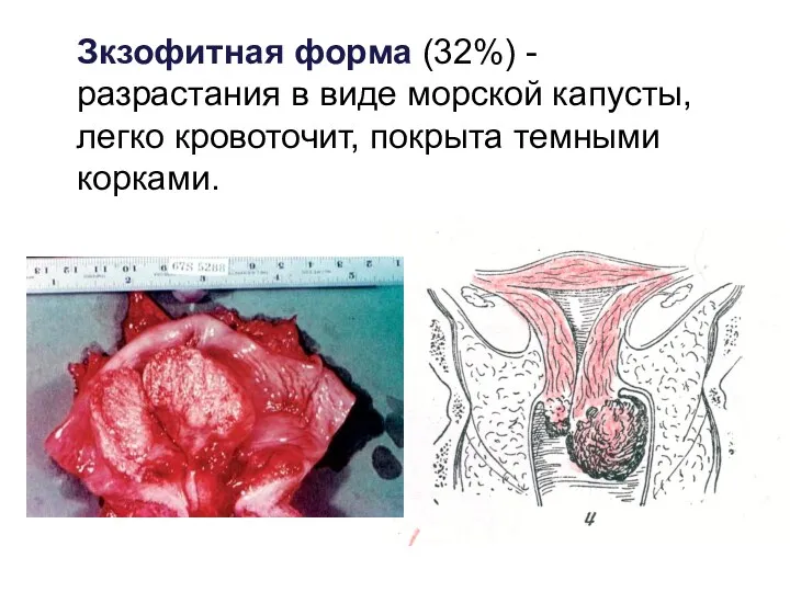 Зкзофитная форма (32%) - разрастания в виде морской капусты, легко кровоточит, покрыта темными корками.