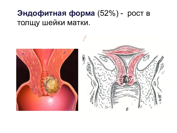 Эндофитная форма (52%) - рост в толщу шейки матки.