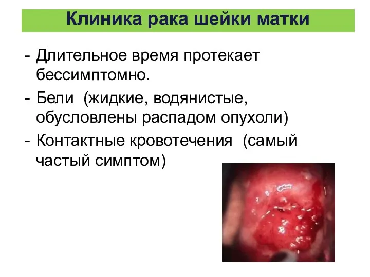 Клиника рака шейки матки Длительное время протекает бессимптомно. Бели (жидкие,