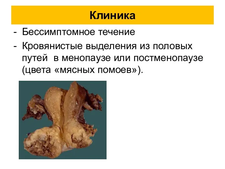 Клиника - Бессимптомное течение - Кровянистые выделения из половых путей в менопаузе или