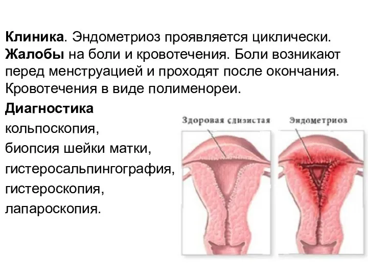 Клиника. Эндометриоз проявляется циклически. Жалобы на боли и кровотечения. Боли