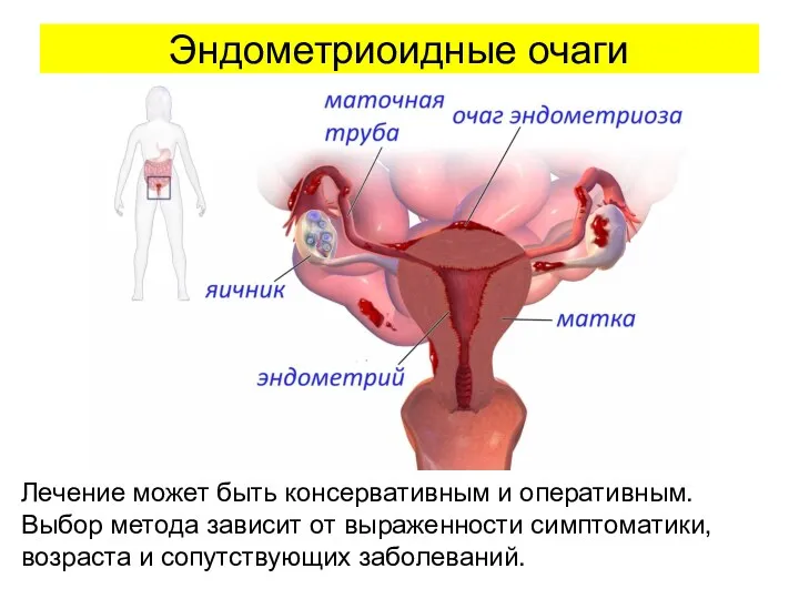 Эндометриоидные очаги Лечение может быть консервативным и оперативным. Выбор метода зависит от выраженности