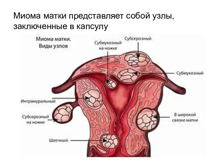 Миома матки представляет собой узлы, заключенные в капсулу