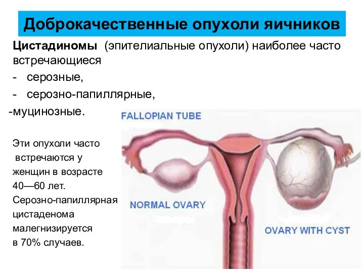 Доброкачественные опухоли яичников Цистадиномы (эпителиальные опухоли) наиболее часто встречающиеся -