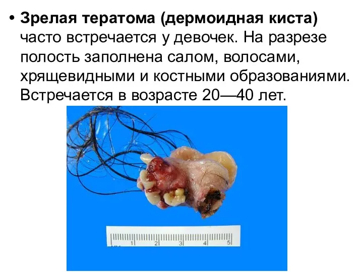 Зрелая тератома (дермоидная киста) часто встречается у девочек. На разрезе полость заполнена салом,