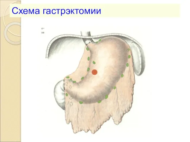 Схема гастрэктомии