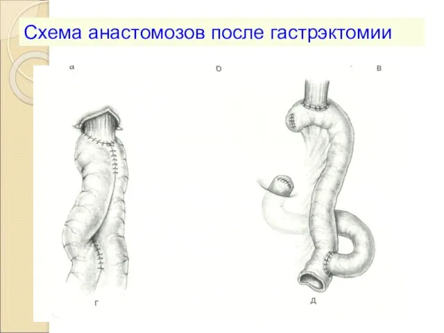 Схема анастомозов после гастрэктомии