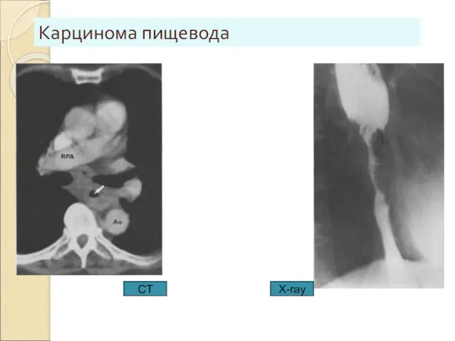 Карцинома пищевода CT X-ray