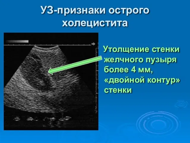 УЗ-признаки острого холецистита Утолщение стенки желчного пузыря более 4 мм, «двойной контур» стенки