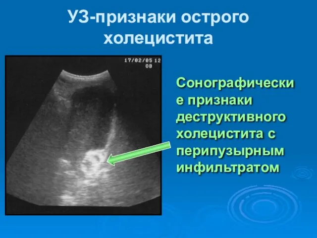 УЗ-признаки острого холецистита Сонографические признаки деструктивного холецистита с перипузырным инфильтратом