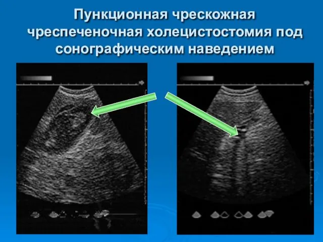 Пункционная чрескожная чреспеченочная холецистостомия под сонографическим наведением