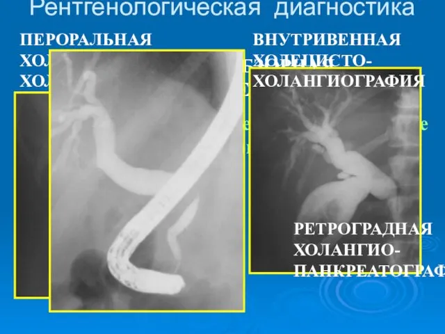 Рентгенологическая диагностика ОБЗОРНАЯ РЕНТГЕНОГРАФИЯ (рентгеноконтрастные конкременты) ПЕРОРАЛЬНАЯ ХОЛЕЦИСТО-ХОЛАНГИОГРАФИЯ ВНУТРИВЕННАЯ ХОЛЕЦИСТО-ХОЛАНГИОГРАФИЯ РЕТРОГРАДНАЯ ХОЛАНГИО-ПАНКРЕАТОГРАФИЯ