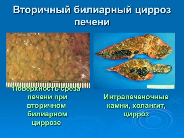 Вторичный билиарный цирроз печени Поверхность среза печени при вторичном билиарном циррозе Интрапеченочные камни, холангит, цирроз