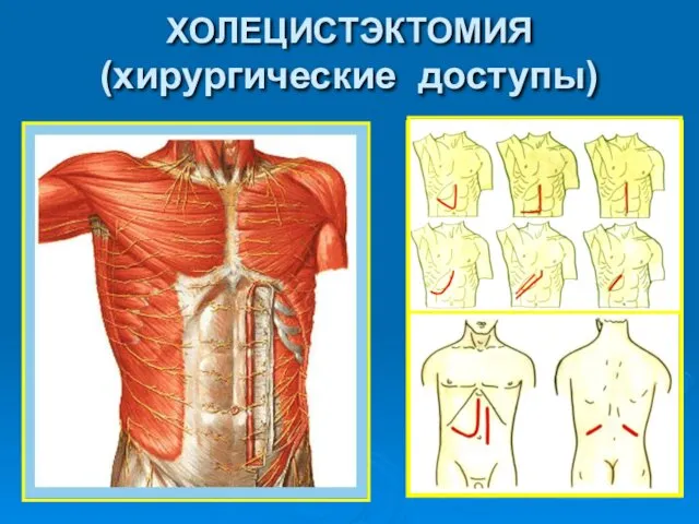 ХОЛЕЦИСТЭКТОМИЯ (хирургические доступы)