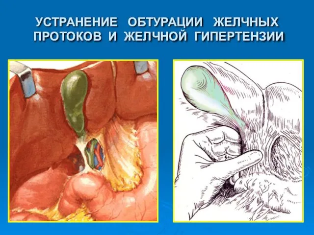 УСТРАНЕНИЕ ОБТУРАЦИИ ЖЕЛЧНЫХ ПРОТОКОВ И ЖЕЛЧНОЙ ГИПЕРТЕНЗИИ