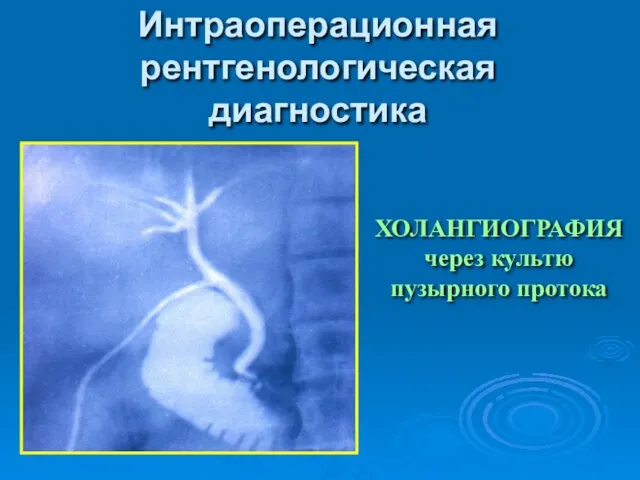 Интраоперационная рентгенологическая диагностика ХОЛАНГИОГРАФИЯ через культю пузырного протока