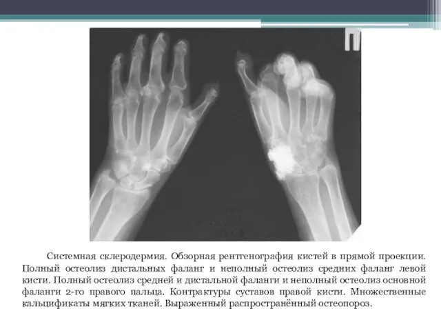 Системная склеродермия. Обзорная рентгенография кистей в прямой проекции. Полный остеолиз