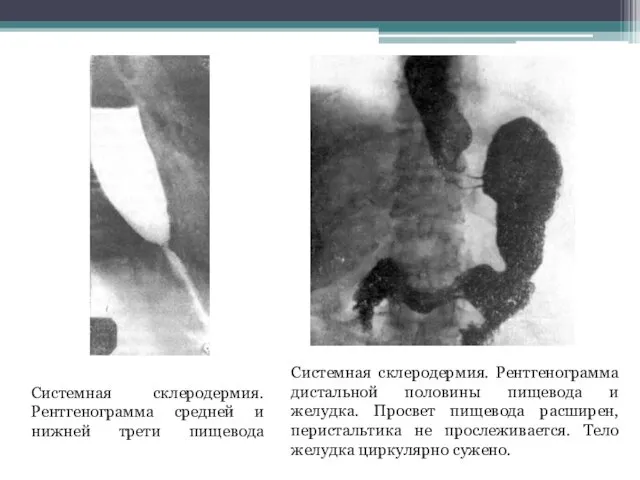 Системная склеродермия. Рентгенограмма средней и нижней трети пищевода Системная склеродермия.