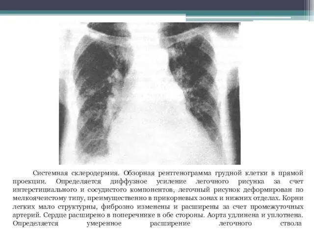 Системная склеродермия. Обзорная рентгенограмма грудной клетки в прямой проекции. Определяется