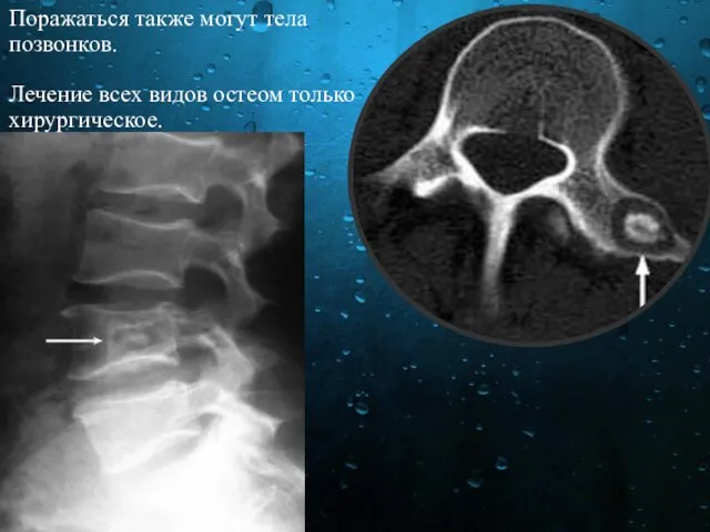 Поражаться также могут тела позвонков. Лечение всех видов остеом только хирургическое.