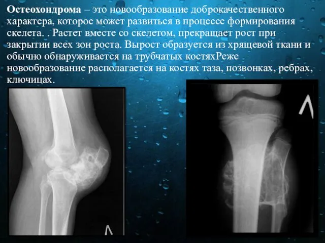 Остеохондрома – это новообразование доброкачественного характера, которое может развиться в