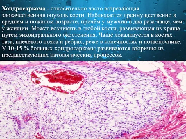 Хондросаркома - относительно часто встречающая злокачественная опухоль кости. Наблюдается преимущественно