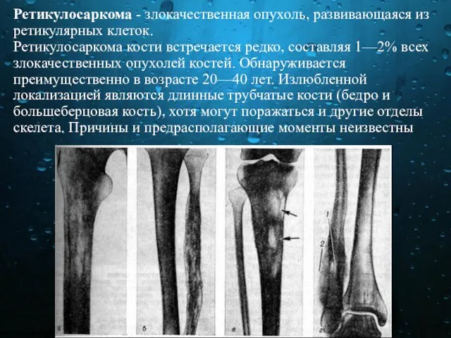 Ретикулосаркома - злокачественная опухоль, развивающаяся из ретикулярных клеток. Ретикулосаркома кости