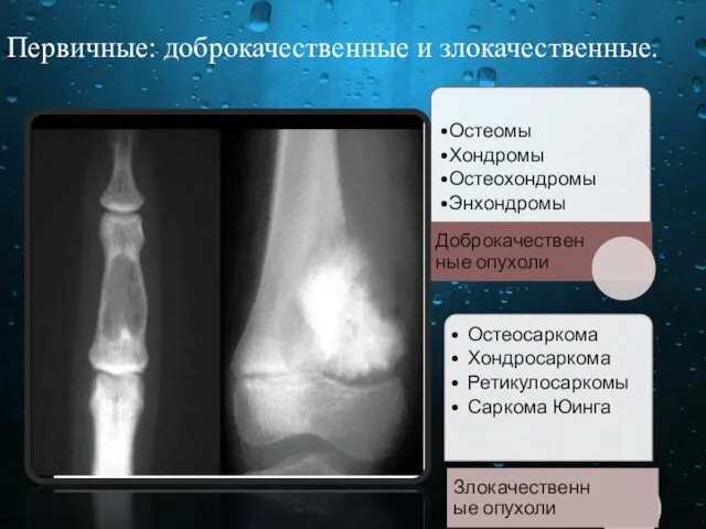 Первичные: доброкачественные и злокачественные.