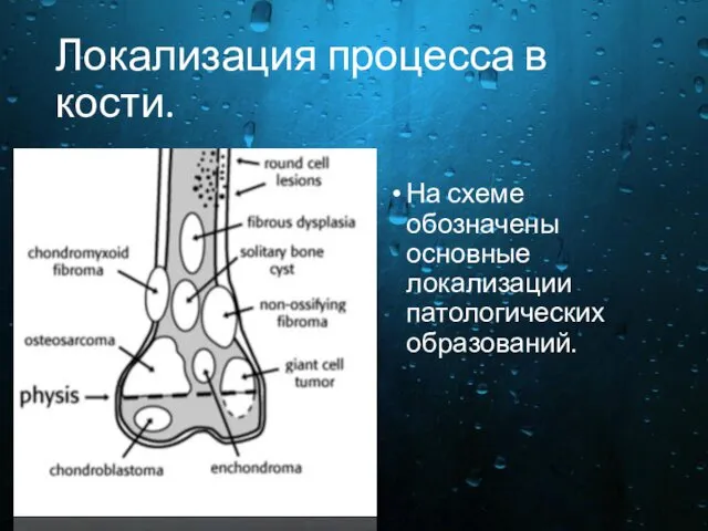 Локализация процесса в кости. На схеме обозначены основные локализации патологических образований.