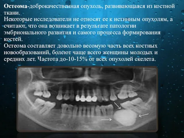 Остеома-доброкачественная опухоль, развивающаяся из костной ткани. Некоторые исследователи не относят