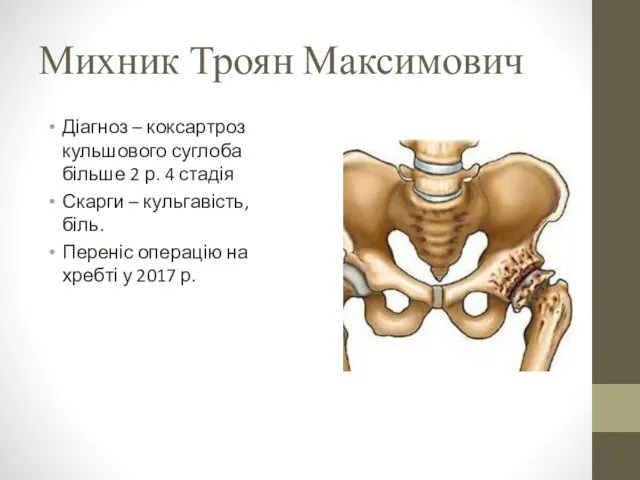 Михник Троян Максимович Діагноз – коксартроз кульшового суглоба більше 2