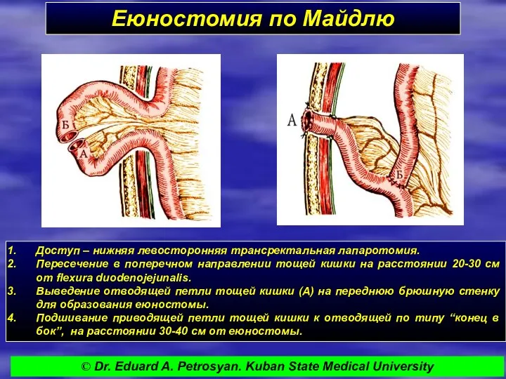 Еюностомия по Майдлю Доступ – нижняя левосторонняя трансректальная лапаротомия. Пересечение в поперечном направлении