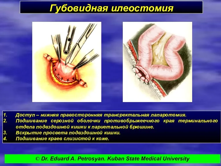 Губовидная илеостомия Доступ – нижняя правосторонняя трансректальная лапаротомия. Подшивание серозной оболочки противобрыжеечного края