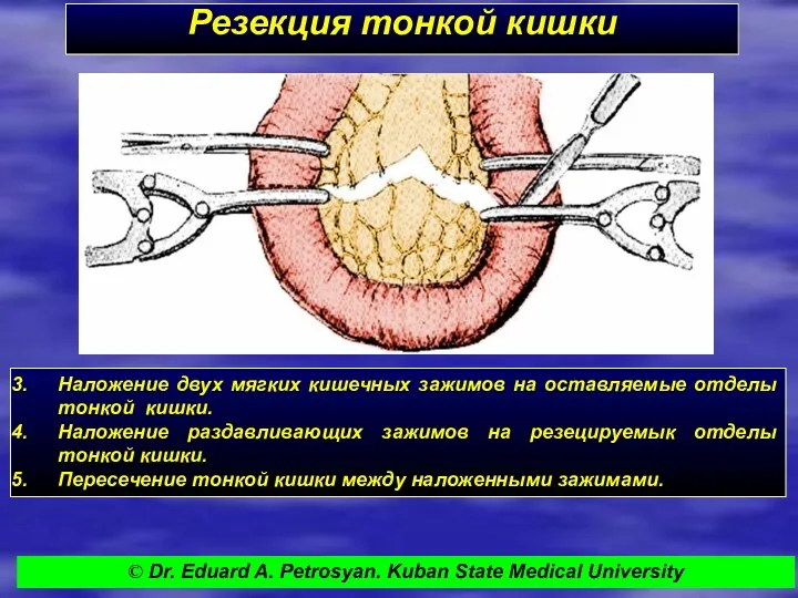 Резекция тонкой кишки Наложение двух мягких кишечных зажимов на оставляемые отделы тонкой кишки.