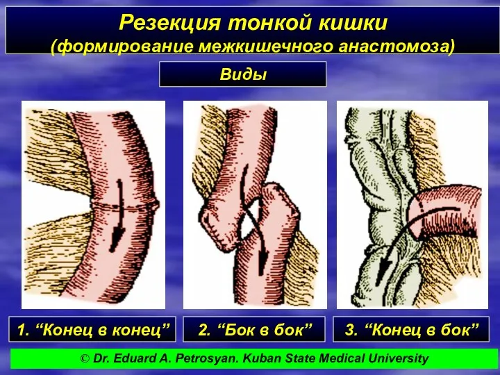 Резекция тонкой кишки (формирование межкишечного анастомоза) Виды 1. “Конец в конец” 2. “Бок