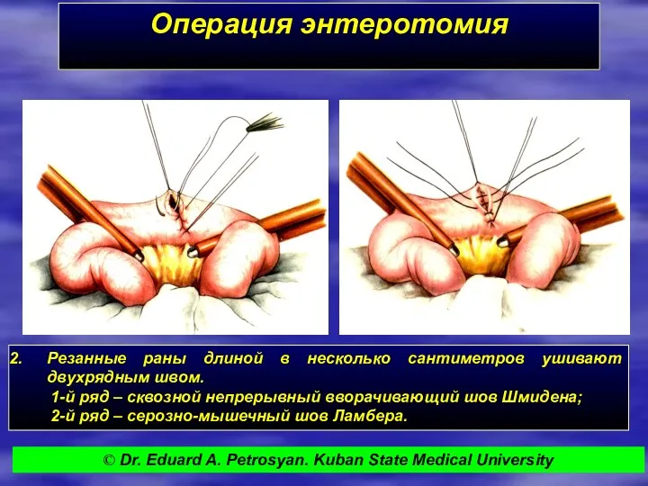 Операция энтеротомия Резанные раны длиной в несколько сантиметров ушивают двухрядным швом. 1-й ряд