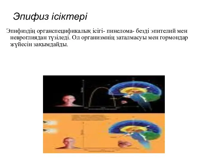 Эпифиз ісіктері Эпифиздің органспецификалық ісігі- пинелома- безді эпителий мен невроглиядан