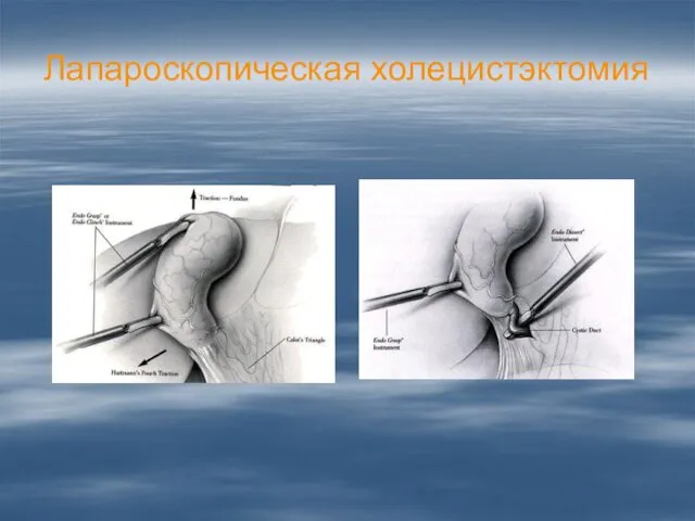 Лапароскопическая холецистэктомия