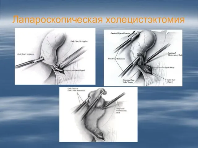 Лапароскопическая холецистэктомия